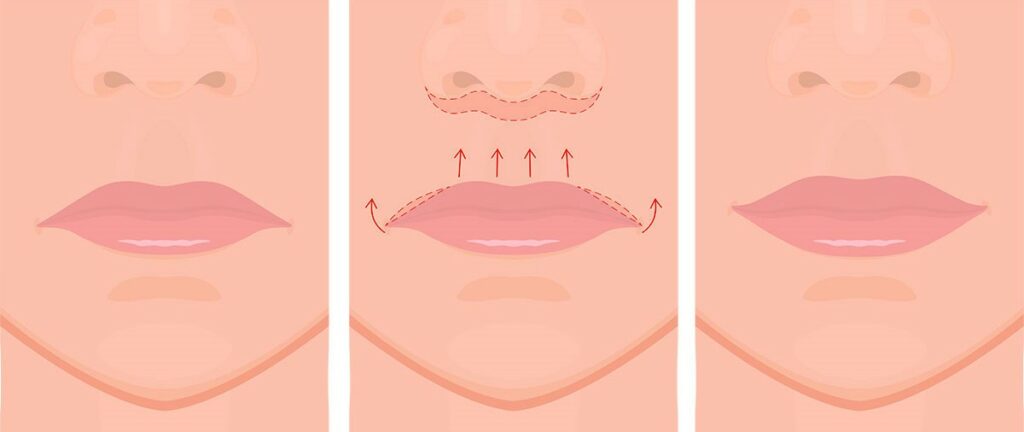 Lip Reshaping Surgery