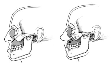 Jaw surgery in Hyderabad