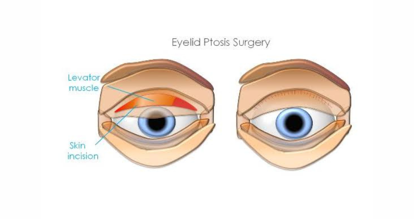 ptosis surgery in hyderabad