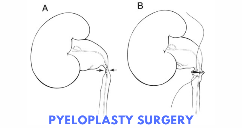 pyeloplasty surgery cost