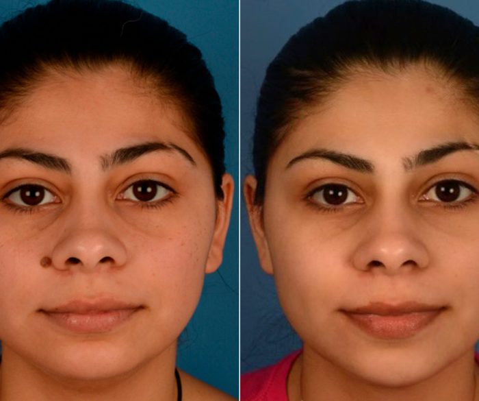 Mole Excision Surgery In Hyderabad