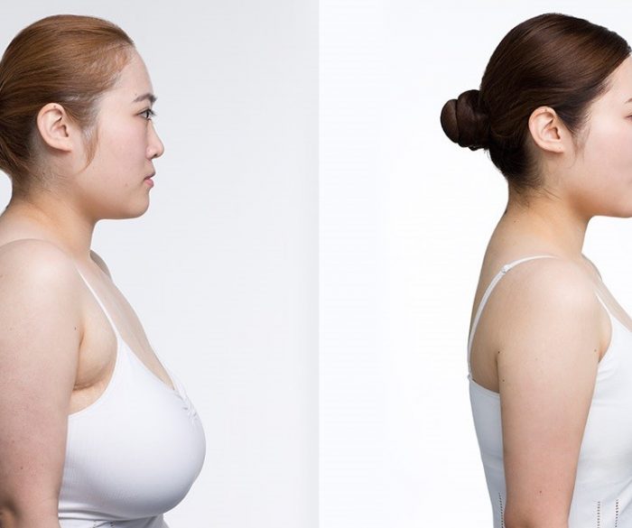 Breast reduction surgery in Hyderabad