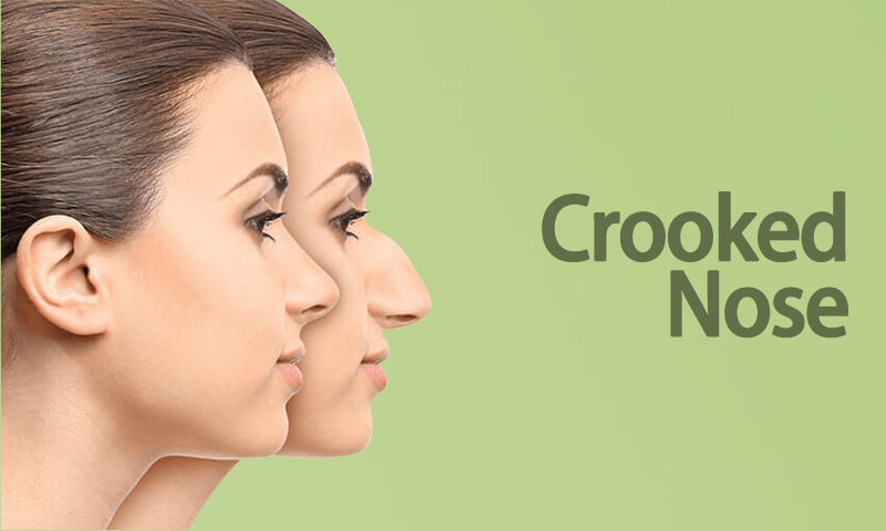 crooked nose surgery cost in india