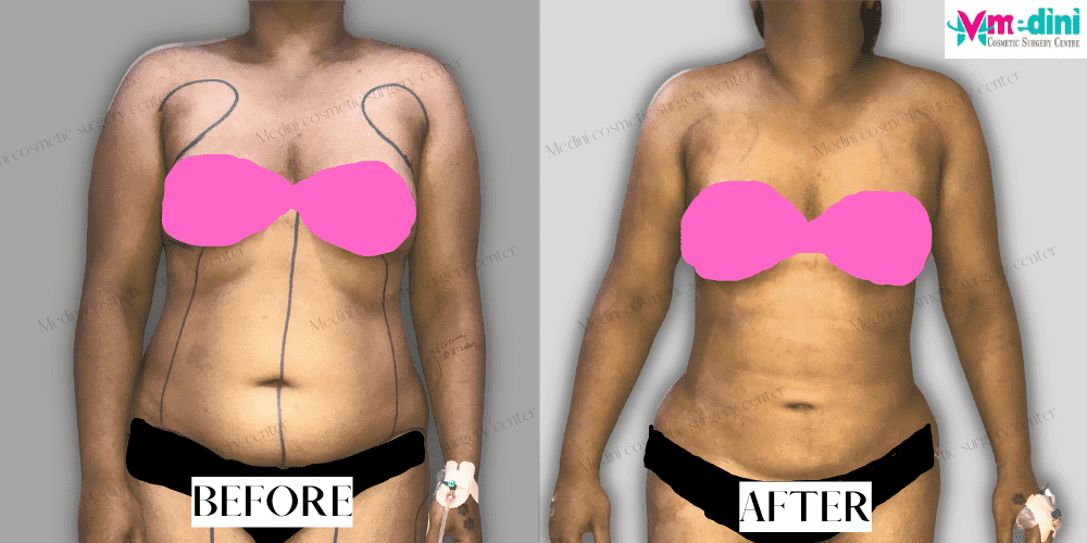 Best Liposuction Before and After -Medini Cosmetic 100% Safe