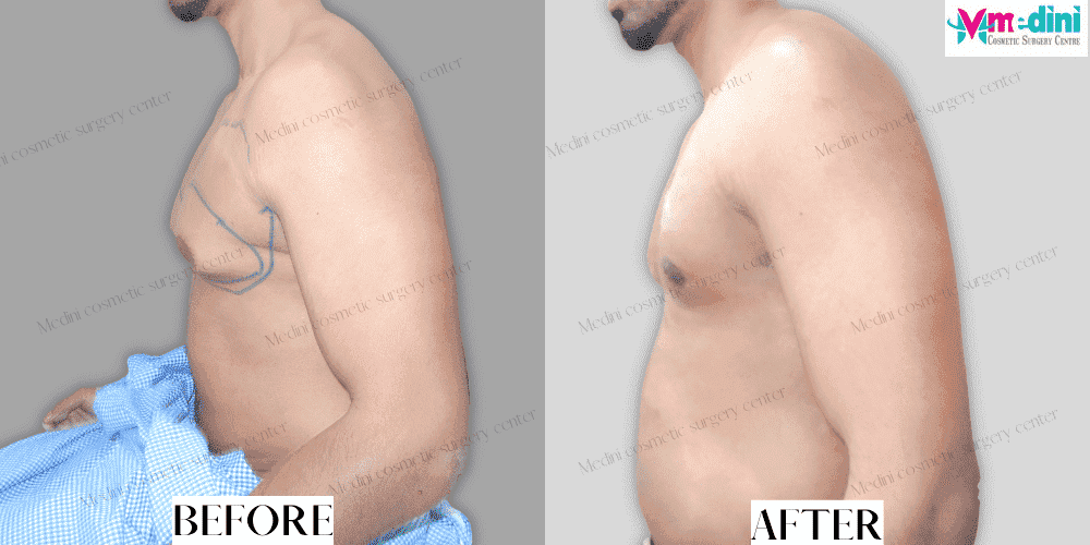 Gynecomastia Surgery Before and After
