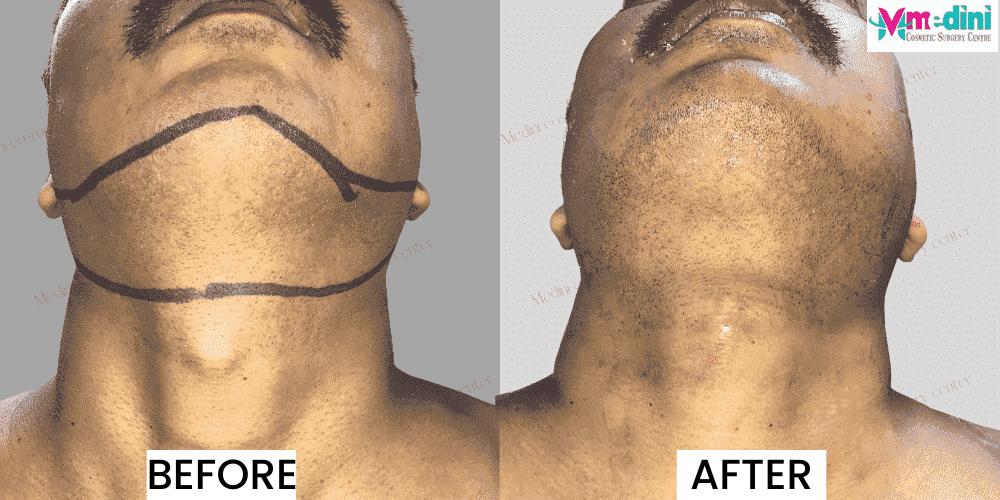 Double chin Liposuction Before and After