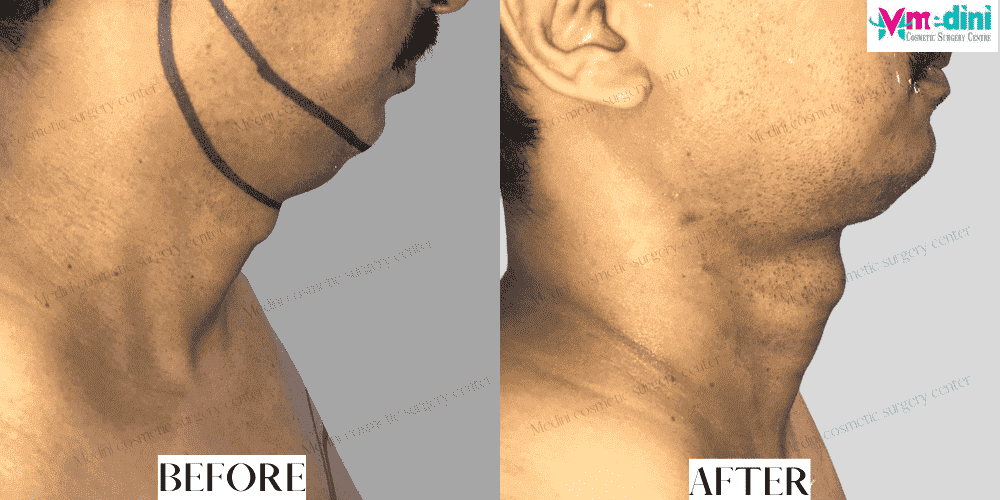 Double chin Liposuction Before and After