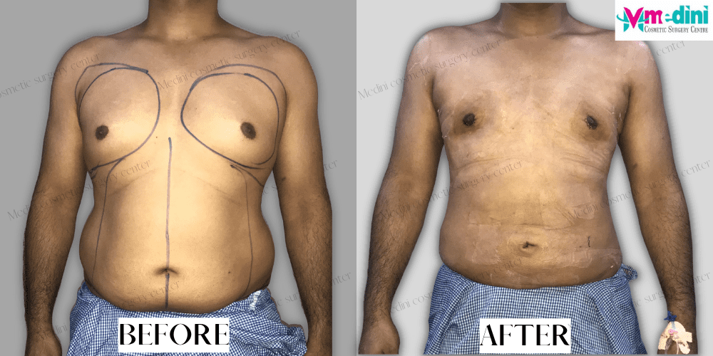 Stomach Liposuction Before and After