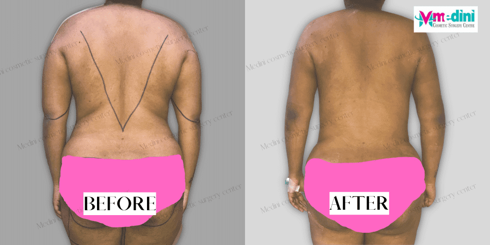 Abdomen Liposuction Before and After