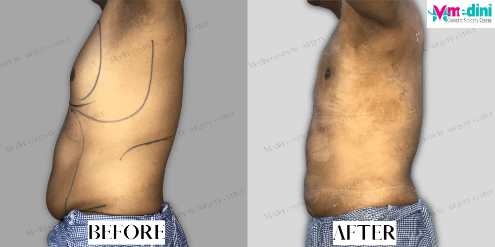 Stomach Liposuction Before and After