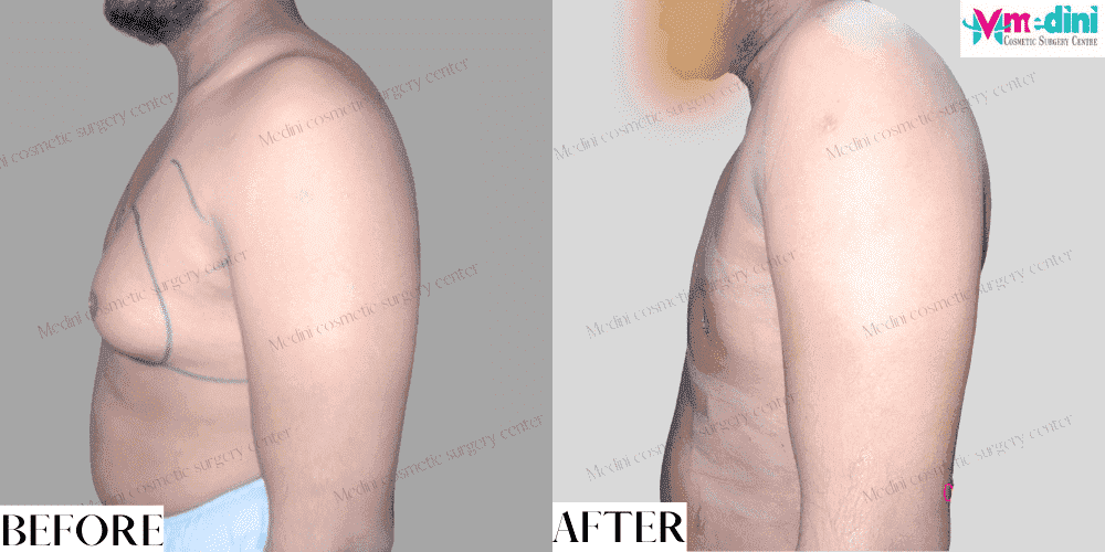 Gynecomastia Surgery Before and After
