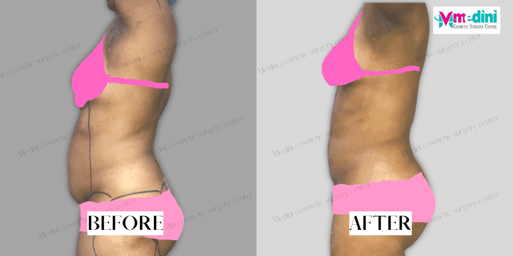 Abdomen Liposuction Before and After