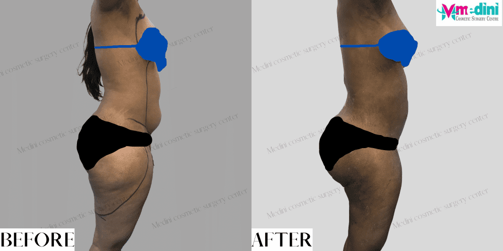 Liposuction Before and After - Abdomen and thighs