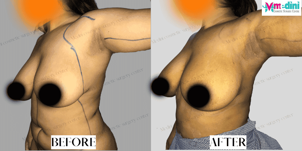 Under Arm Liposuction Before and After