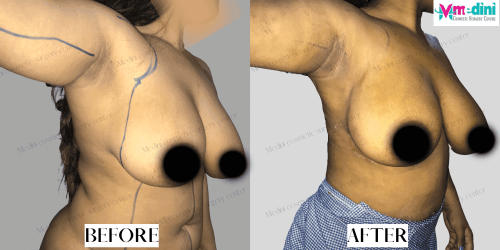 Under arm Liposuction Before and After