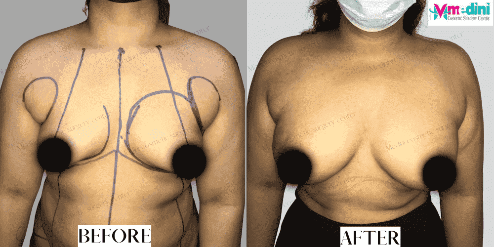 Breast Enlargement Boob Job Before and after