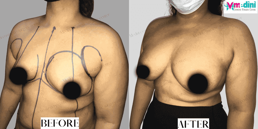 Breast Enlargement Boob Job Before and after