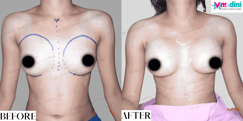 Breast augmentation Boob Job Before and after