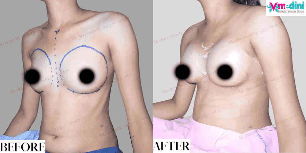 Breast augmentation Boob Job Before and after