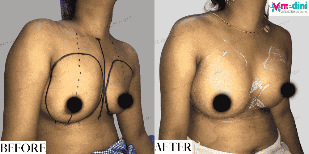 Breast Implants Augmentation Boob Job Before and after