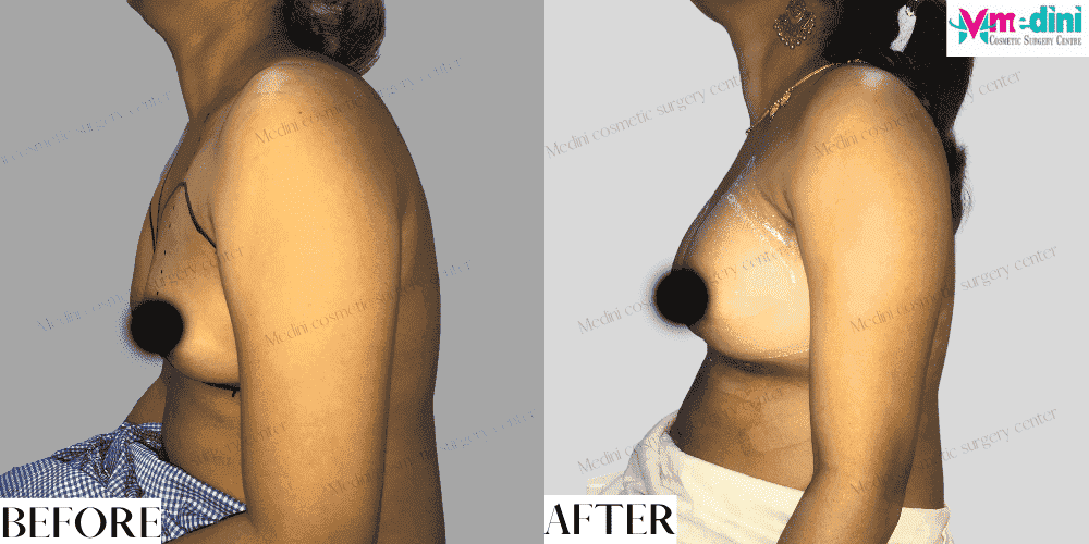 Breast Implants Augmentation Boob Job Before and after