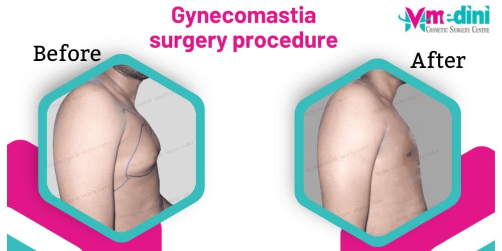 Gynecomastia Surgery procedure