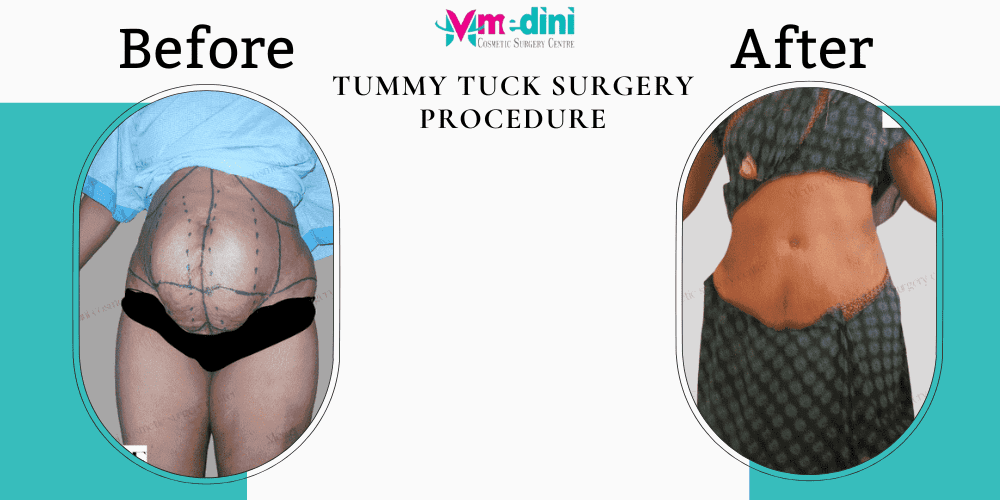Tummy Tuck Surgery Procedure